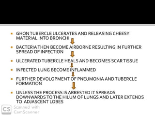 PULMONARY TUBERCULOSIS