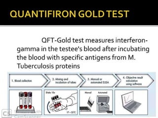PULMONARY TUBERCULOSIS