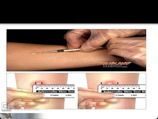 PULMONARY TUBERCULOSIS