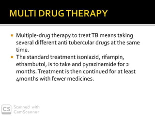 PULMONARY TUBERCULOSIS