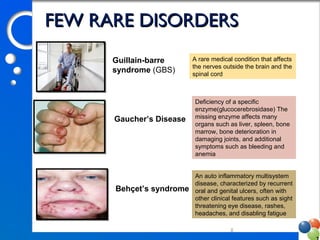 8
A rare medical condition that affects
the nerves outside the brain and the
spinal cord
Deficiency of a specific
enzyme(glucocerebrosidase) The
missing enzyme affects many
organs such as liver, spleen, bone
marrow, bone deterioration in
damaging joints, and additional
symptoms such as bleeding and
anemia
An auto inflammatory multisystem
disease, characterized by recurrent
oral and genital ulcers, often with
other clinical features such as sight
threatening eye disease, rashes,
headaches, and disabling fatigue
FEW RARE DISORDERSFEW RARE DISORDERS
Guillain­barre
syndrome (GBS)
Gaucher’s Disease
Behçet’s syndrome
 