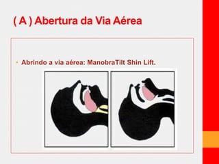 ( A ) Abertura da Via Aérea 
• Abrindo a via aérea: ManobraTilt Shin Lift. 
 