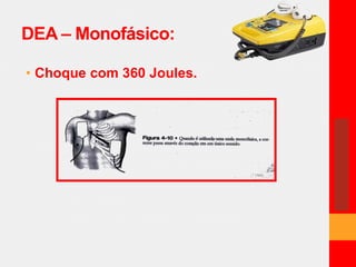 DEA – Monofásico: 
• Choque com 360 Joules. 
 