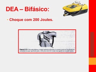 DEA – Bifásico: 
• Choque com 200 Joules. 
 