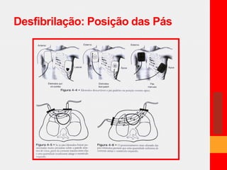Desfibrilação: Posição das Pás 
 