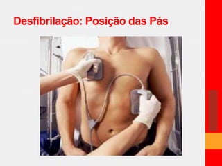Desfibrilação: Posição das Pás 
 