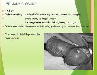 PRIMARY CLOSURE
 If <3 cm
 Galea scoring :- method of decreasing tension on wound margins
avoid injury to major vessel
1 mm gain in each incision, keep 1 cm gap
 Obtain meticulous hemostasis following galeotomy to prevent hematoma

 Chances of distal flap vascular
compromise
 