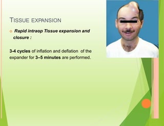 TISSUE EXPANSION
 Rapid intraop Tissue expansion and
closure :
3-4 cycles of inflation and deflation of the
expander for 3–5 minutes are performed.
 