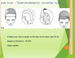 JURI - TEMPOROPARIETO-
FLAP OCCIPITAL FLAP
If defect size <25 cm length as this flap can be taken upto 25 cm
Based on Parietal br . Of STA
Delay needed
 