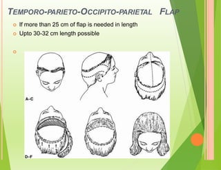 TEMPORO-PARIETO-OCCIPITO-PARIETAL
 If more than 25 cm of flap is needed in length
 Upto 30-32 cm length possible
FLAP

 
