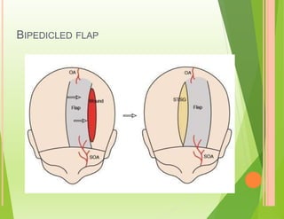 BIPEDICLED FLAP
 