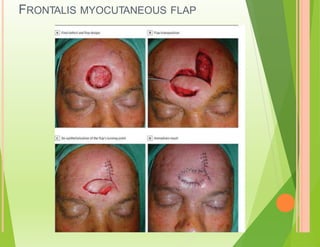 FRONTALIS MYOCUTANEOUS FLAP
 