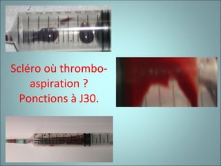Scléro où thrombo-aspiration ? Ponctions à J30. 