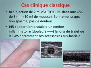Cas clinique classique J0 : injection de 2 ml d’AETOXI 2% dans une GVS de 8 mm (10 ml de mousse). Bon remplissage, bon spasme, pas de douleur. J45 : apparition brutale d’un cordon inflammatoire (douleurs +++) le long du trajet de la GVS notamment ses accessoires sus-fasciale. 