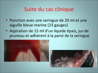 Suite du cas clinique Ponction avec une seringue de 20 ml et une aiguille bleue marine (23 gauges) Aspiration de 15 ml d’un liquide épais, jus de pruneau et adhérent à la paroi de la seringue  