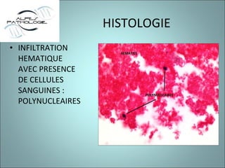 HISTOLOGIE INFILTRATION HEMATIQUE AVEC PRESENCE DE CELLULES SANGUINES : POLYNUCLEAIRES 