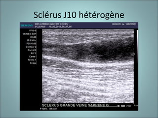 Sclérus J10 hétérogène 
