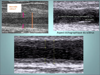 Aspect échographique du sclérus  