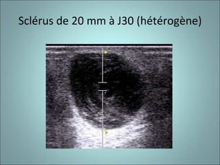Sclérus de 20 mm à J30 (hétérogène) 