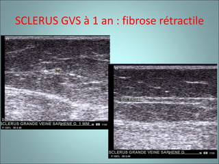 SCLERUS GVS à 1 an : fibrose rétractile 
