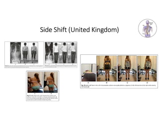 Side Shift Method PPT Fisioterapi pada kasus Scoliosis.pdf