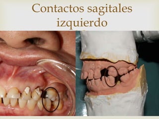 
Contactos sagitales
izquierdo
 