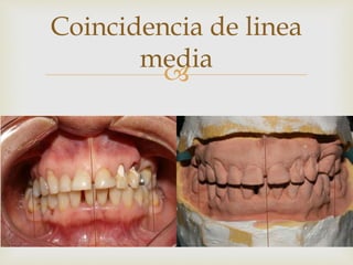 
Coincidencia de linea
media
 