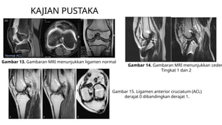 Comparative Study of Ultrasound and MRI in Diagnosing ACL Tears in Genu ...