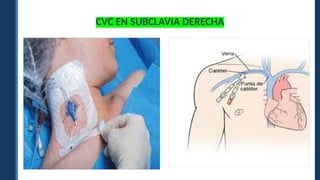 CVC EN SUBCLAVIA DERECHA
 