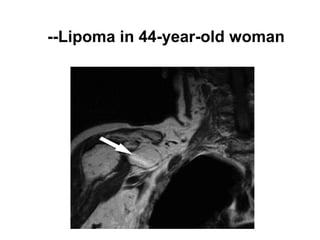 --Lipoma in 44-year-old woman
 