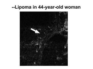 --Lipoma in 44-year-old woman
 