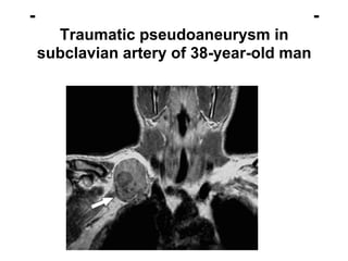- -
Traumatic pseudoaneurysm in
subclavian artery of 38-year-old man
 