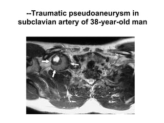 --Traumatic pseudoaneurysm in
subclavian artery of 38-year-old man
 