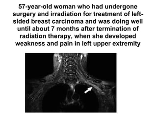 57-year-old woman who had undergone
surgery and irradiation for treatment of left-
sided breast carcinoma and was doing well
until about 7 months after termination of
radiation therapy, when she developed
weakness and pain in left upper extremity
 