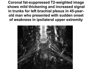 Coronal fat-suppressed T2-weighted image
shows mild thickening and increased signal
in trunks for left brachial plexus in 45-year-
old man who presented with sudden onset
of weakness in ipsilateral upper extremity
 