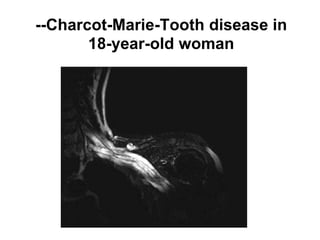 --Charcot-Marie-Tooth disease in
18-year-old woman
 
