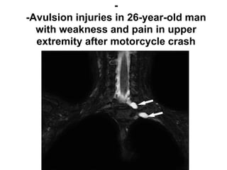 -
-Avulsion injuries in 26-year-old man
with weakness and pain in upper
extremity after motorcycle crash
 