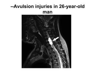 --Avulsion injuries in 26-year-old
man
 