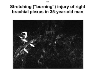 --
Stretching ("burning") injury of right
brachial plexus in 35-year-old man
 
