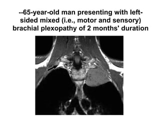 --65-year-old man presenting with left-
sided mixed (i.e., motor and sensory)
brachial plexopathy of 2 months' duration
 