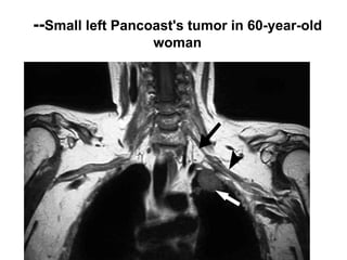 --Small left Pancoast's tumor in 60-year-old
woman
 