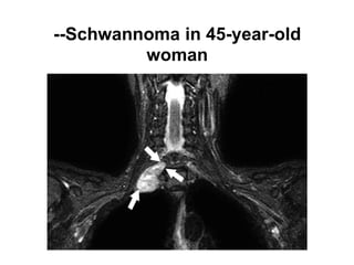 --Schwannoma in 45-year-old
woman
 