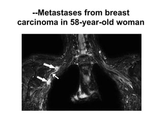 --Metastases from breast
carcinoma in 58-year-old woman
 