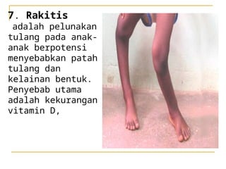 Orang Rakitis PPT SISTEM GERAK PADA MANUSIA KELAS XI.ppt