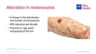 © 2019 Medline Industries, Inc.
• A change in the distribution
and number of melanocytes
• 40% reduction per decade
• Presents as “age spots”
and graying of the hair
Alteration in melanocytes
Skin and the Aging Process7
References: WOCN Core Curriculum
U.S. Census Bureau, An Aging Nation: The Older Population in the United States. May 2014
 
