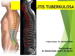SPONDILITIS TUBERKULOSA
T. Bima Fasha. TS 2207601100003
Pembimbing :
dr. Nanta Aulia, SpOT (K) Spine
 