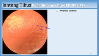 1. Miokard Vertikel
29
1
 