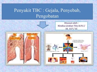 Penyakit TBC : Gejala, Penyebab,
Pengobatan
Disusun oleh :
Nindica Lindian Titis D.P.S /
16. 117 / 1C
 