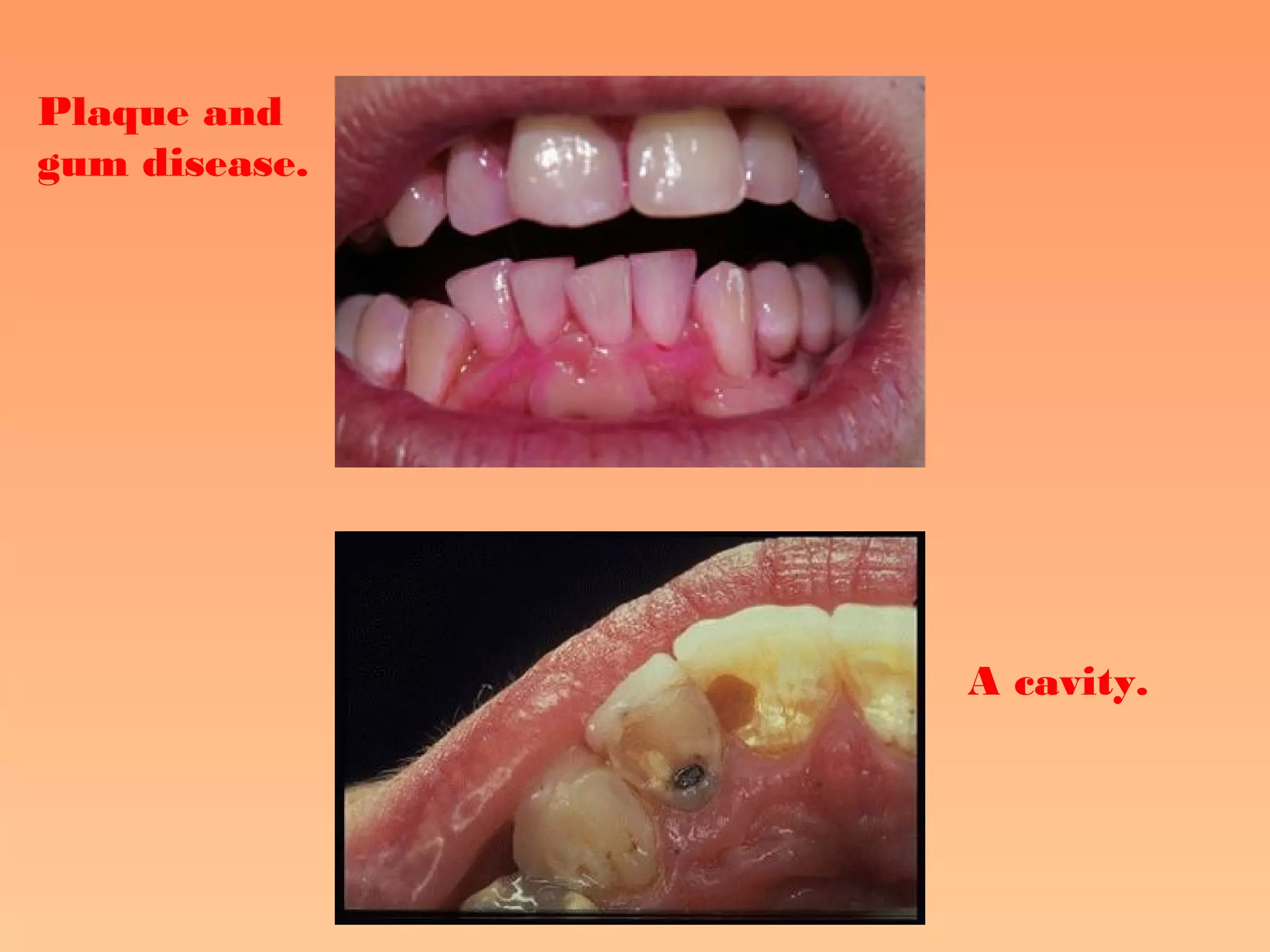 Plaque and
gum disease.
A cavity.