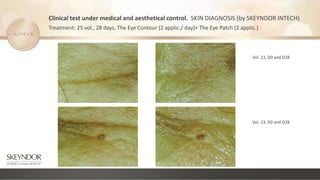 Vol. 23, D0 and D28
Vol. 23, D0 and D28
Clinical test under medical and aesthetical control. SKIN DIAGNOSIS (by SKEYNDOR INTECH)
Treatment: 25 vol., 28 days, The Eye Contour (2 applic./ day)+ The Eye Patch (2 applic.)
 